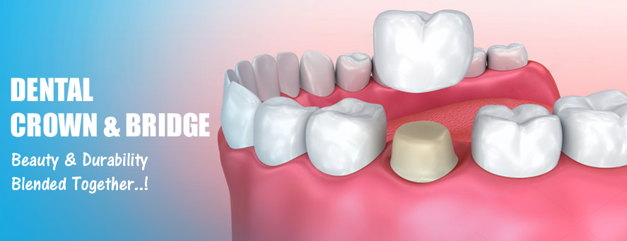 dental crown and bridge
