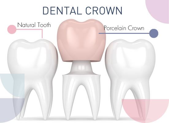 dental crown