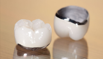 Ceramic-fused-to-metal crowns