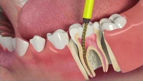 root canal treatment angamaly